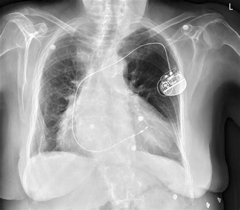 Pacemaker Icd Cxr Figure 2 From Evaluation And Monitoring Of Patients