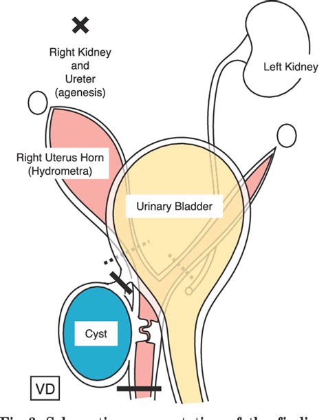 Gartner Duct Cyst Anatomy