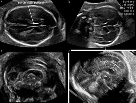Diagnosis Of Midline Anomalies Of The Fetal Brain With The Three
