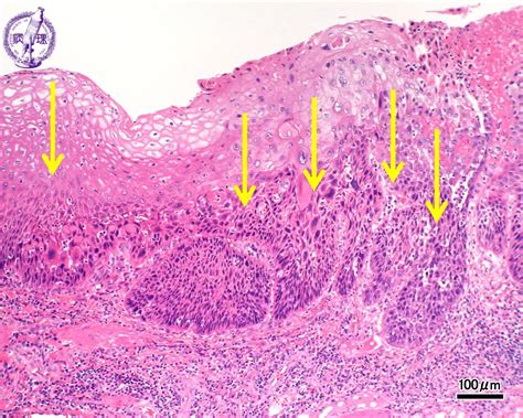 8esophagus Stomach 3 Esophageal Carcinoma Squamous Cell Carcinoma