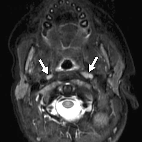 Retropharyngeal Lymph Nodes In Children A Common Imaging Finding And