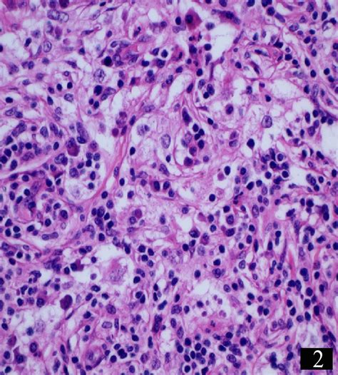 Radiological Features Of Rosaidorfman Disease Case Series And Review