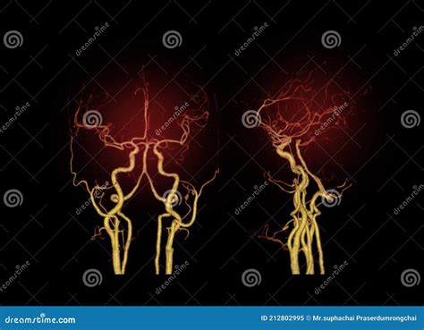Cta Brain Or Ct Angiography Of The Brain 3d Rendering Image Ap And