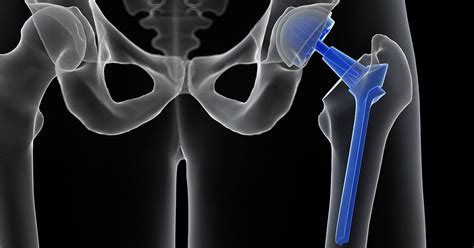 Hip Replacement Surgery Pontchartrain Orthopedics
