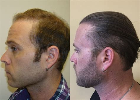 Complete Crown Coverage Incredible Hair Transplant Results