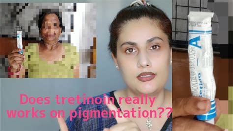 I Tried Tretinoin On Pigmentation And Here Are The Results देखिए