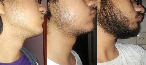 Minoxidil O Que É E Como Usar Para Fazer Sua Barba Crescer Moda Para Homens