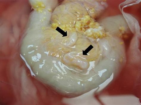 Check spelling or type a new query. Chronic pancreatitis — Medlibes: Online Medical Library