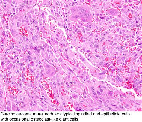 Pathology Outlines Mural Nodules In Mucinous Cystic Neoplasms