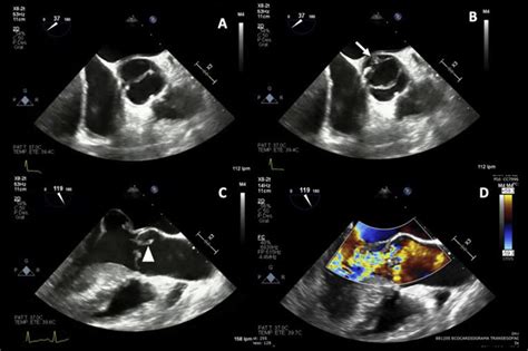 Tee A B Aortic Valve Short Axis View Bicuspid Aortic Valve With
