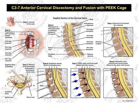 C Anterior Cervical Discectomy And Fusion With Peek Cage