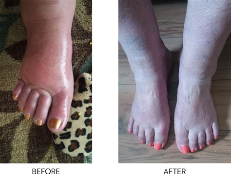 Diabetes Leg Discoloration