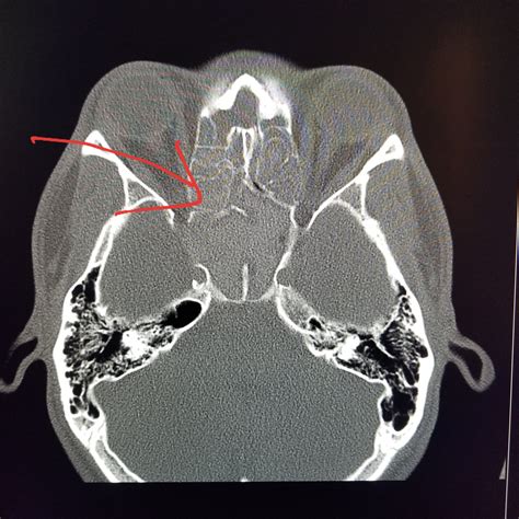 Head Ct Shows Severe Sinusitis With The Sinuses Completely Blocked
