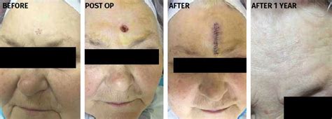 Mohs Surgery Before And After