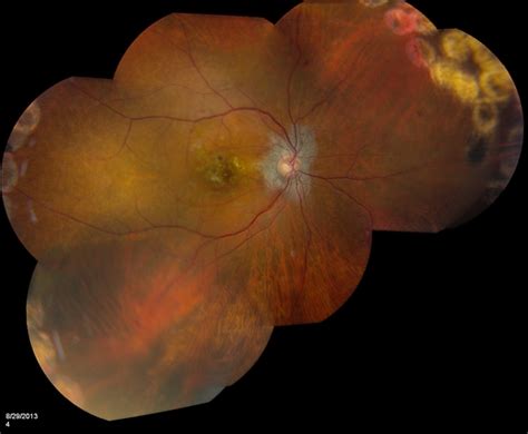 Cystoid Macular Edema Retina Image Bank