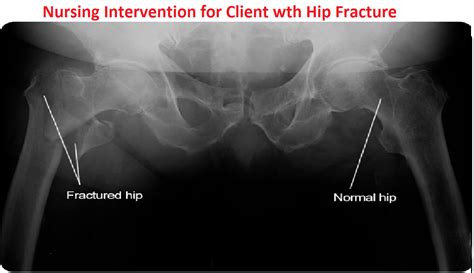 Nursing Intervention For Client Wth Hip Fracture Nursing Care Plan