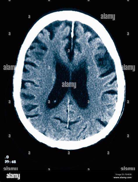 Ct Scan 84 Year Old Male With Alzheimers Disease Ct Shows Brain Stock