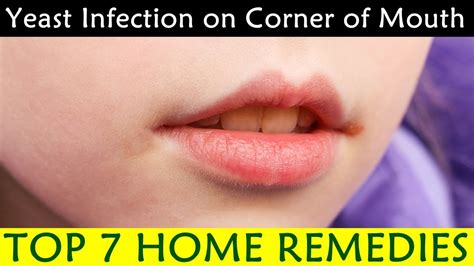 Yeast Infection On Corner Of Mouth Causes Symptoms Prevention Home