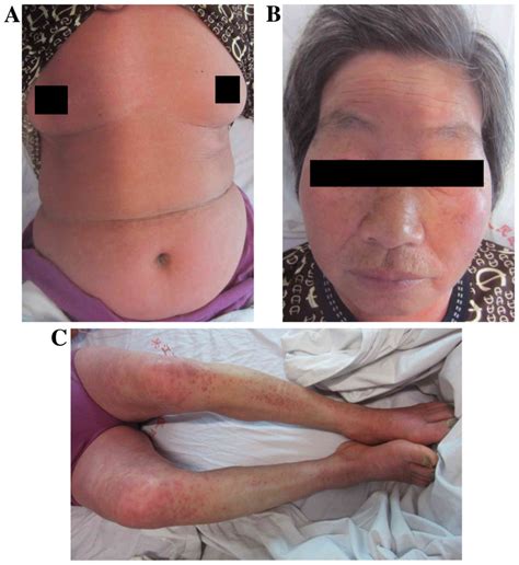 Severe Erythema Multiforme‑type Drug Eruption Controlled By Tumor