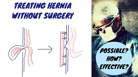 Treating Hernia Without Surgery Youtube