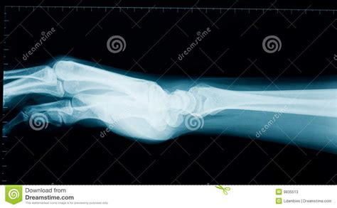 Hand Wrist X Ray Stock Image Image Of People Bone