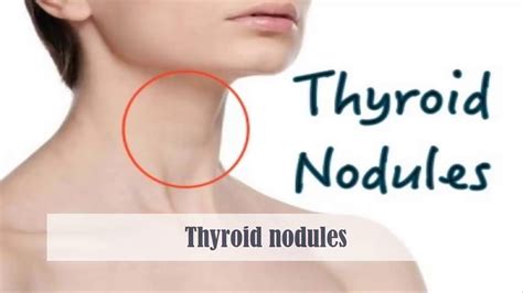 Swollen Thyroid Gland In Neck Symptoms