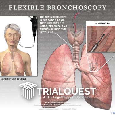 Flexible Bronchoscopy Trialexhibits Inc