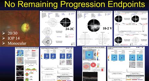 Detecting Progression In Severe Glaucoma