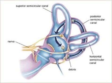 Learn why this happens and how to put loose ear crystals back in place. BPPV (Vertigo) - Peak Sports And Spine Centre