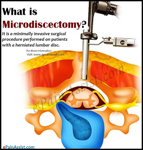 What Is Microdiscectomy How Is It Done Its Recovery Time And Success Rate