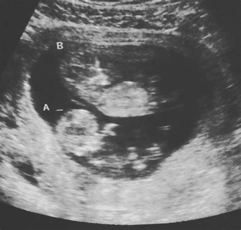 10 Weeks Pregnant Ultrasound Twins
