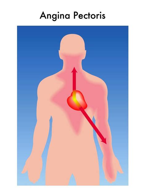 Angina Cardiology Highland Hospital University Of Rochester
