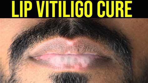 Lip Vitiligo Cure Leucoderma On Lips Treatment Lip Vitiligo Tattoo