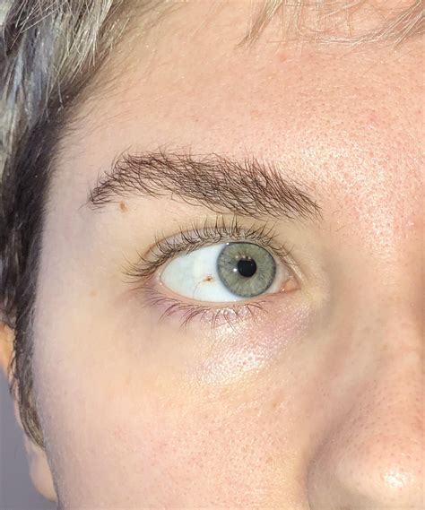 I Have A Freckle On The White Of My Eye Rmildlyinteresting