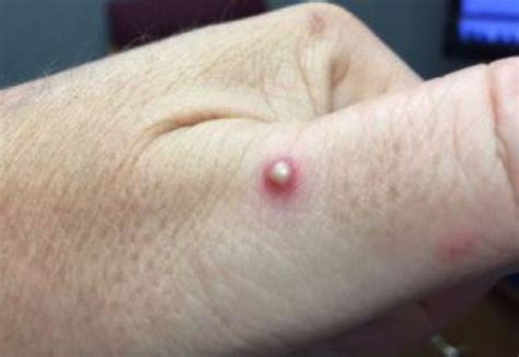 Alcune fiale come farsi le punture di eparina? Come riconoscere le punture degli insetti - pestbusters.it