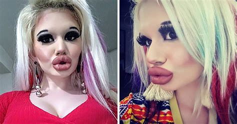 Une jeune étudiante a triplé le volume de ses lèvres pour être à la mode