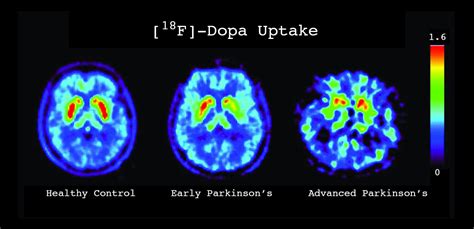 The Dat Scan Does Not Diagnose Parkinsons · Parkinsons Resource