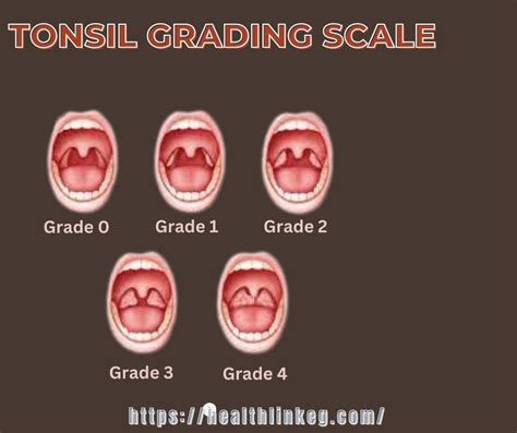 The Big Value From Using Tonsil Grading Scale The Scale In 2024