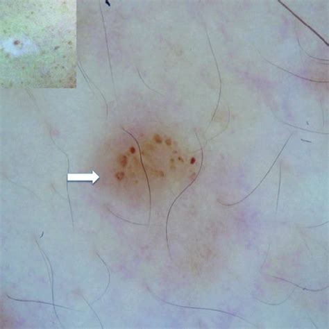 Pdf Criterios Dermatoscópicos De Halo Nevo Y Halo Melanoma