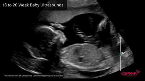 20 Week Baby Hiccups Pregnancy