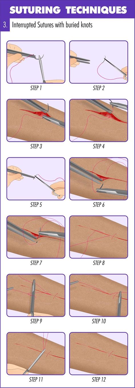 Complete Guide To Mastering Suturing Techniques Medical Emergency