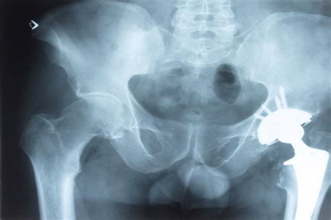 Depuy Hip Implants Class Action Lawsuit Klein Lawyers