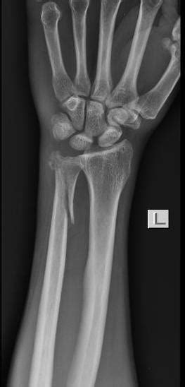 Radius And Ulnar Shaft Fractures Trauma Orthobullets