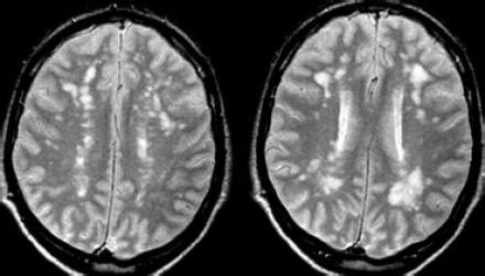 Check spelling or type a new query. The Radiology Assistant : Multiple Sclerosis