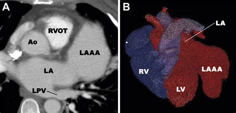 Giant Congenital Left Atrial Appendage Aneurysm Presenting With
