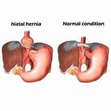 Hiatal Hernia Pain Relief Treatment Pictures