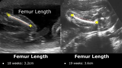 Femur Length Ultrasound Normal Values Femoral Length Measurements