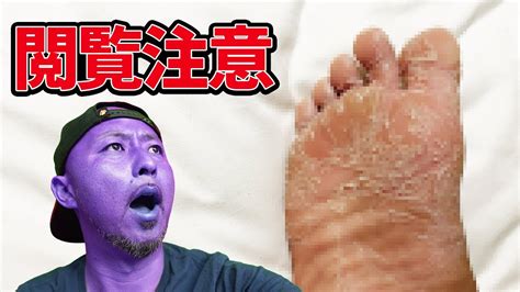 【閲覧注意】足の皮がごっそりズルむけ！ Youtube