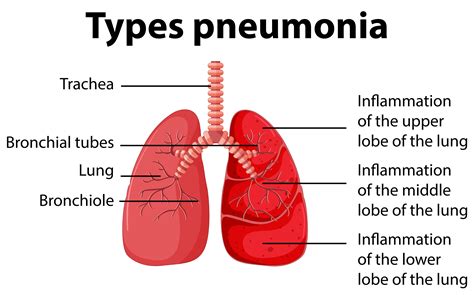 Phases Of Pneumonia