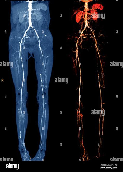 La Enfermedad Vascular 2d Color Izquierda Y 3d Derecha La